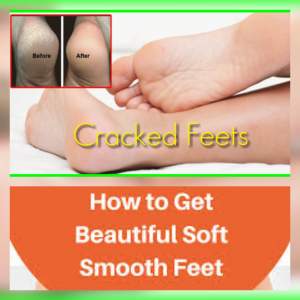 Cracked heels - Manicure products on Aster Vender