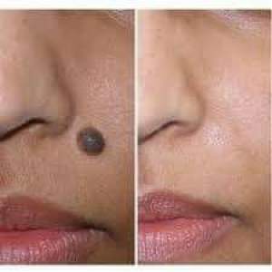 Remove skin tags warts core mole and craproche with laser  - Other Hair Removal Products