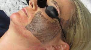 Carbon peeling treatment - 0 - Other Body Care Products  on Aster Vender