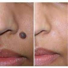 Remove skin tags warts core mole and craproche with laser   on Aster Vender